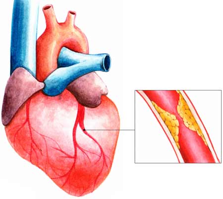 XỬ TRÍ NHỒI MÁU CƠ TIM