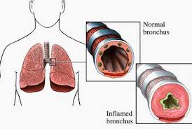 Hen phế quản thể nặng (Asthme SéVère)