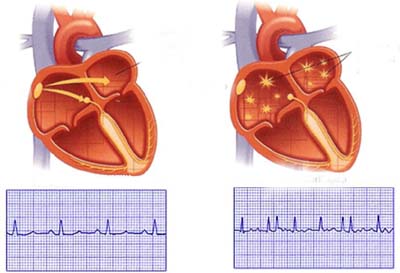 Loạn nhịp nhanh (Tachyarrhythmias)