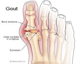 Chẩn đoán và điều trị bệnh Gút