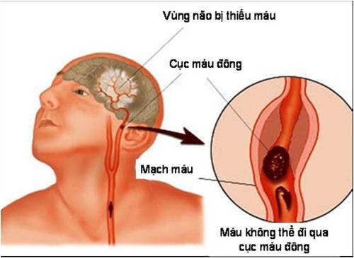 CHẨN ĐOÁN VÀ XỬ TRÍ CẤP CỨU ĐỘT QUỴ CẤP ĐẾN SỚM TRONG 3 GIỜ ĐẦU TẠI KHOA CẤP CỨU