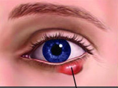 Viêm bờ mi – Căn bệnh nhiều người chưa biết