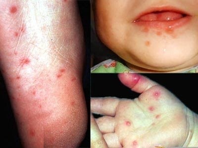 Những bệnh truyền nhiễm dễ lây