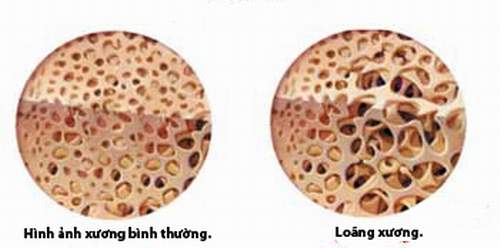 Bệnh loãng xương sau sinh.