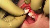Xử trí răng rơi ra khỏi xương ổ