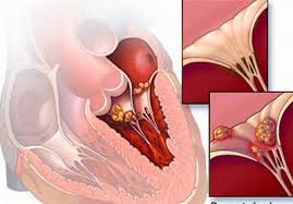 Điều trị các bệnh van tim 