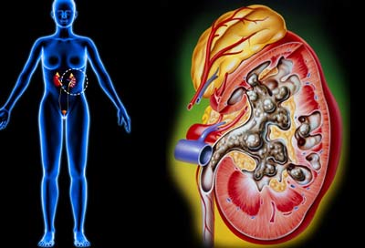 Cơn đau quặn thận cấp do sỏi niệu quản