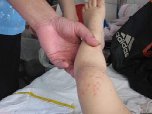 Bệnh tay chân miệng và cách phòng ngừa