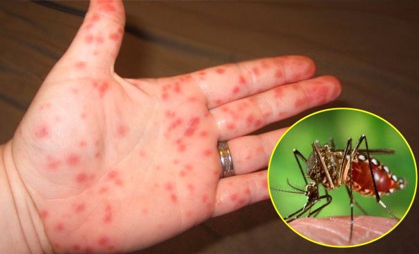 Phòng, chống bệnh sốt xuất huyết Dengue năm 2020