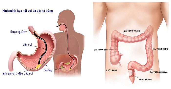 TRUNG TÂM Y TẾ HUYỆN KIM THÀNH TRIỂN KHAI KỸ THUẬT NỘI SOI TIÊU HÓA HIỆN ĐẠI